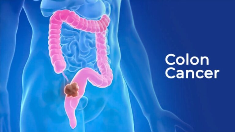 Colon Cancer in 2026: A Science-Based Overview of Modern Drugs, Research, and Treatment Approaches
