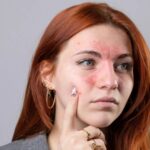 Eczema Explained in Simple Terms: Understanding Causes, Symptoms, and Management Strategies for Better Skin Health