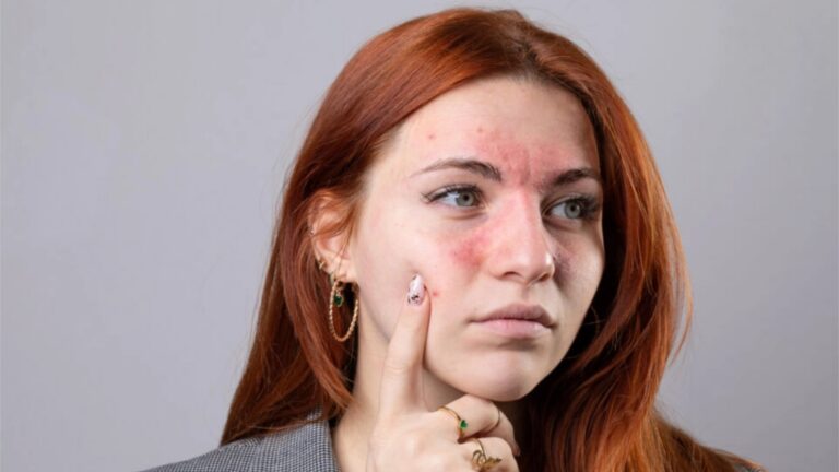 Eczema Explained in Simple Terms: Understanding Causes, Symptoms, and Management Strategies for Better Skin Health